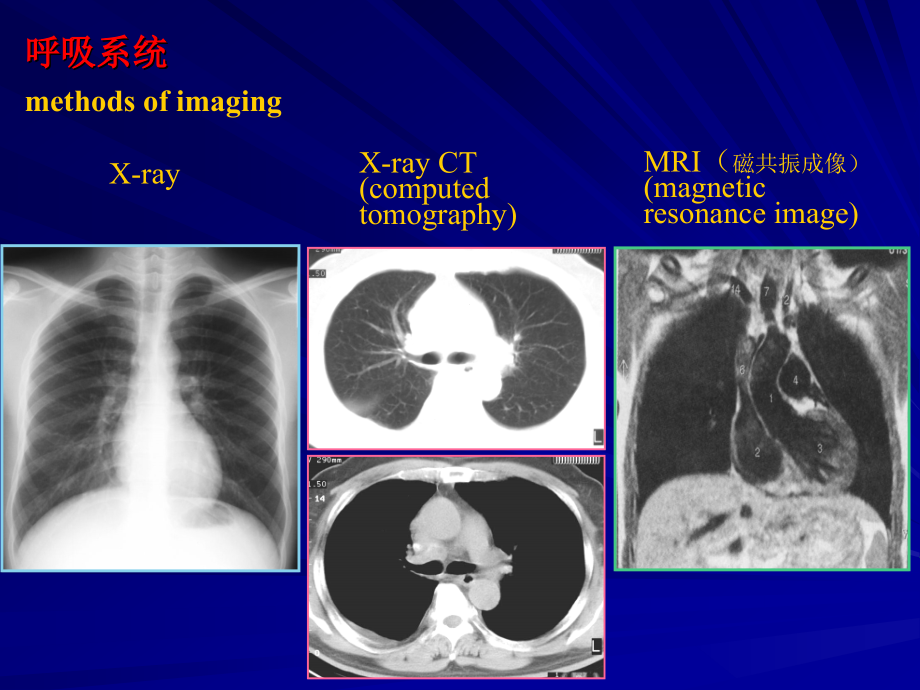 normal chest x-ray recognition of structures(学生讲课)_第2页