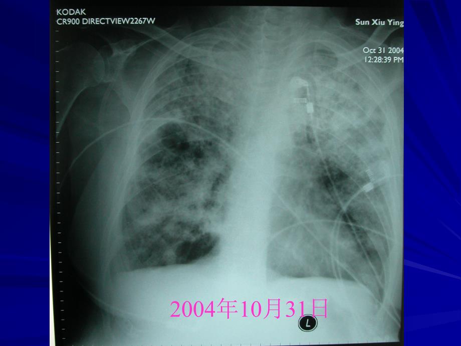 院内感染细菌耐药问题与抗生素应用策略_第4页