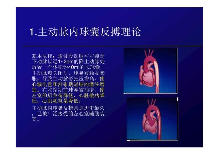 iabp的临床使用及护理_第4页