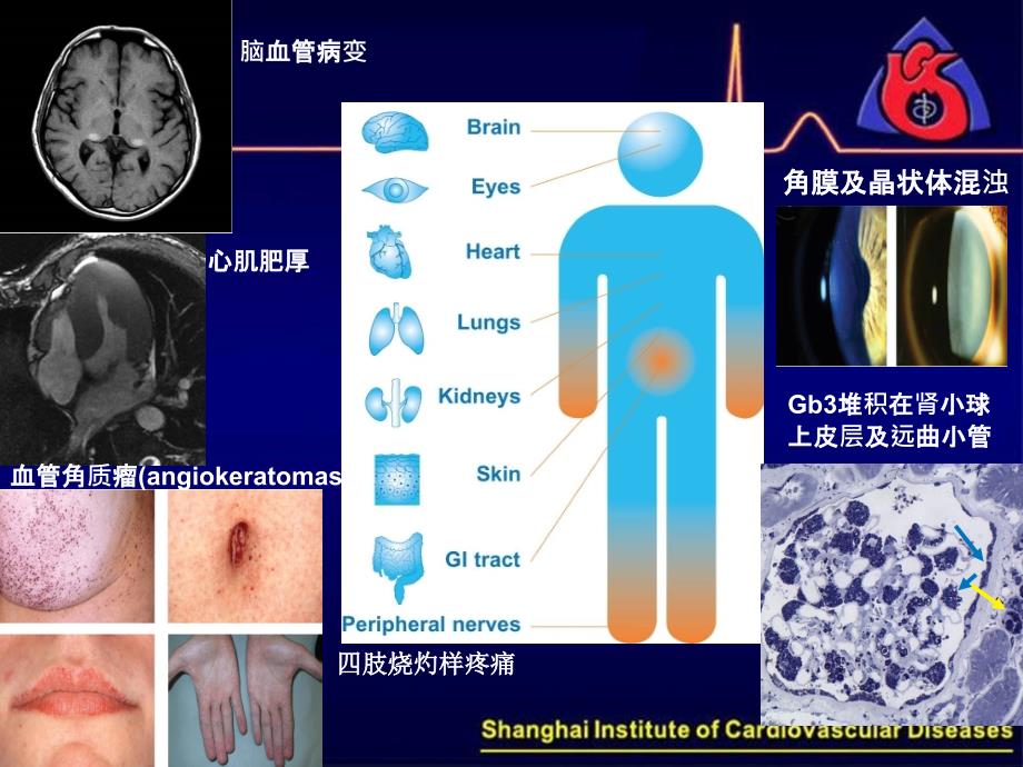 fabry病与心肌损害_第4页