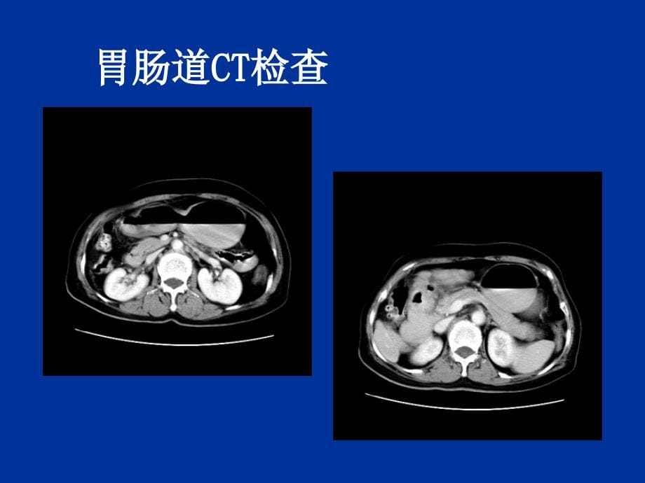 医学影像诊断PPT课件图文详解-消化系统影像诊断_第5页