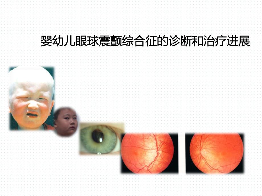 婴幼儿眼球震颤综合征的诊断和治疗进展_第1页