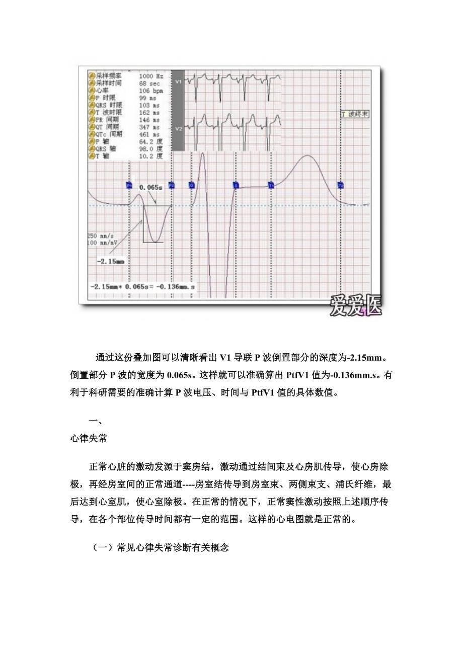 第十三讲正常心电图心律失常要点_第5页