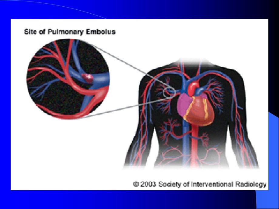 肺栓塞护理查房-ppt_第3页
