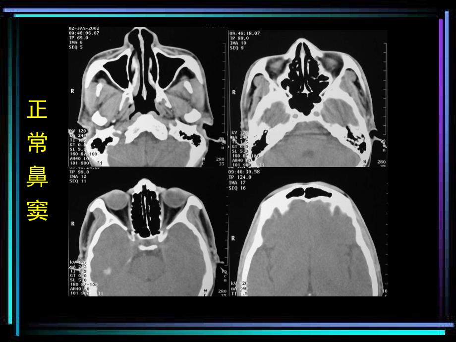 ct诊断学鼻与鼻窦ct_第4页