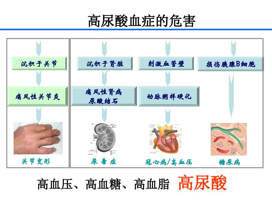 高尿酸血症与痛风-未来第四高_第4页