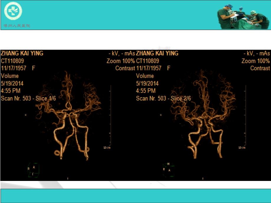 脑动脉解剖及ct重建_第4页