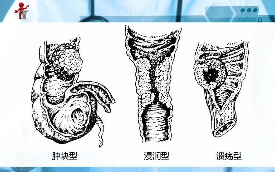 《外科护理》第十五章 第七节结、直肠癌病人护理_第5页