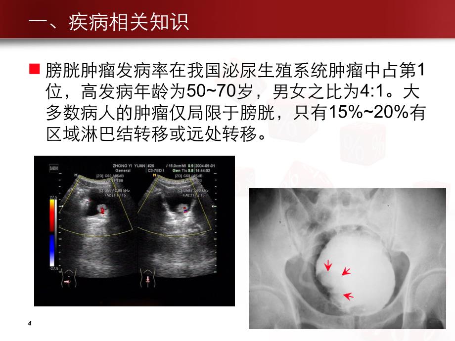 泌尿1：膀胱肿瘤病人护理查房_第4页