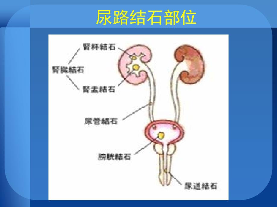 尿路结石现代综合治疗[1]_第2页