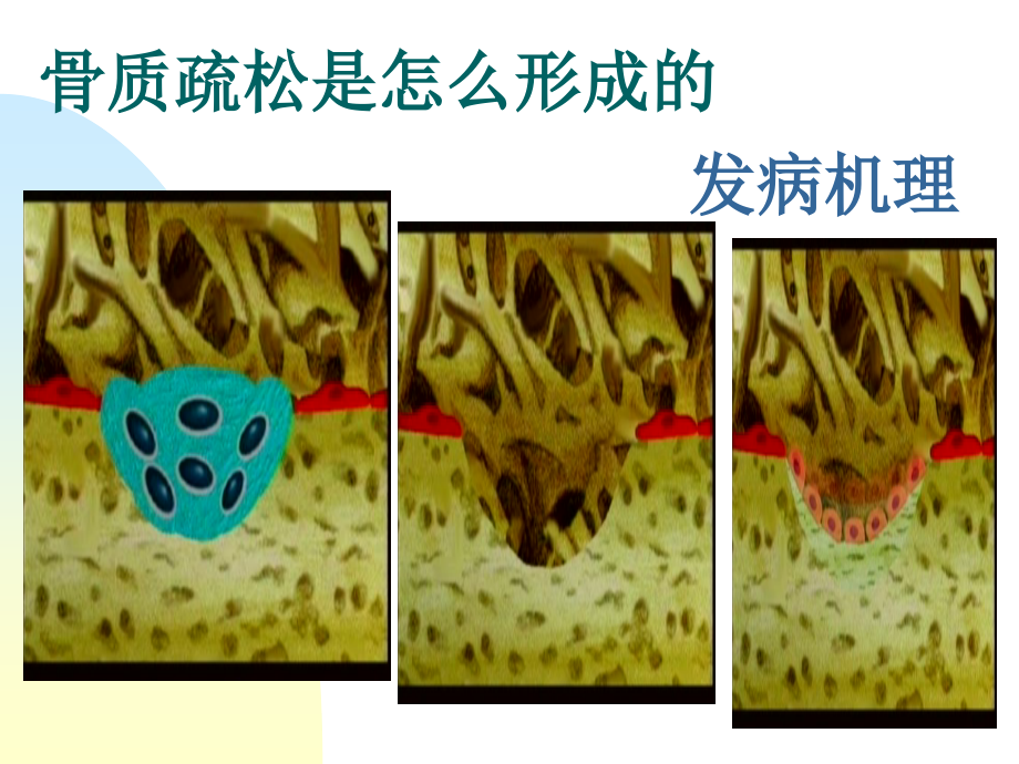 骨质疏松症预防及保健_第4页