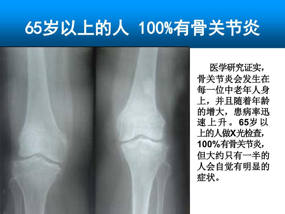 氨糖及骨关节病_第3页