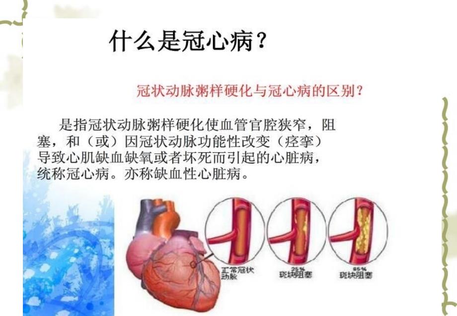 张晶---pci术的护理查房剖析_第2页