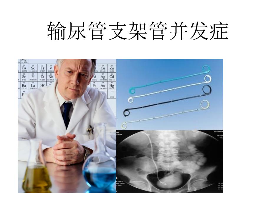 输尿管支架管并发症剖析_第1页