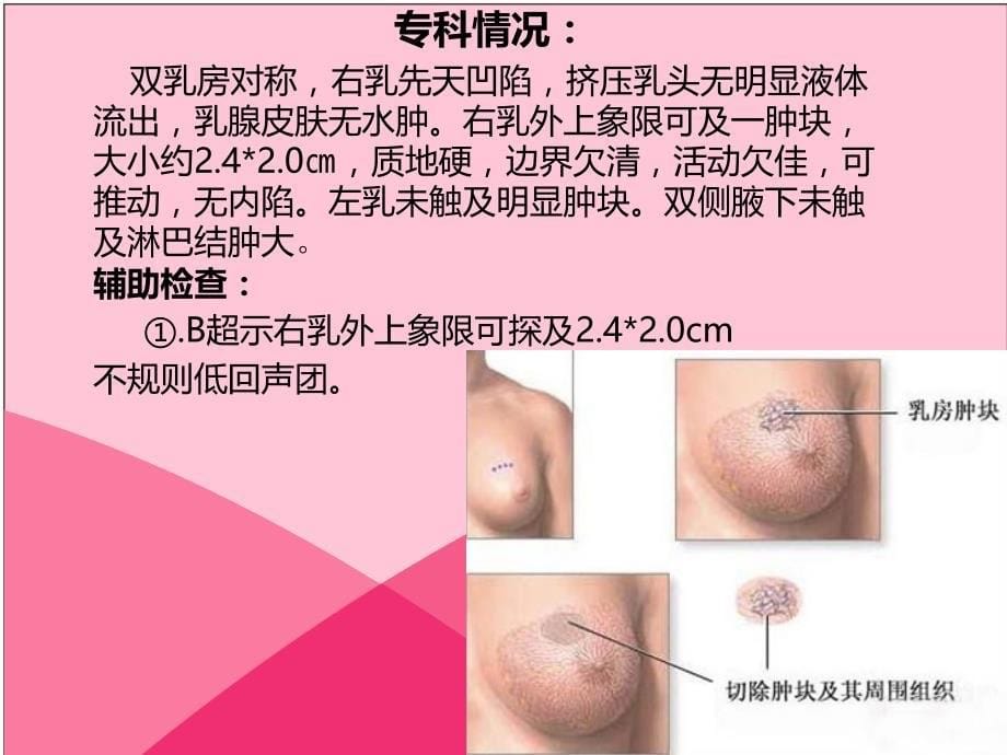 乳腺癌合并糖尿病护理_第5页