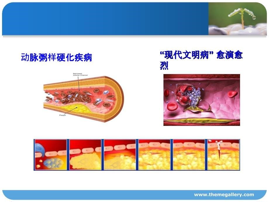 冠心病介入治疗及护理剖析_第5页