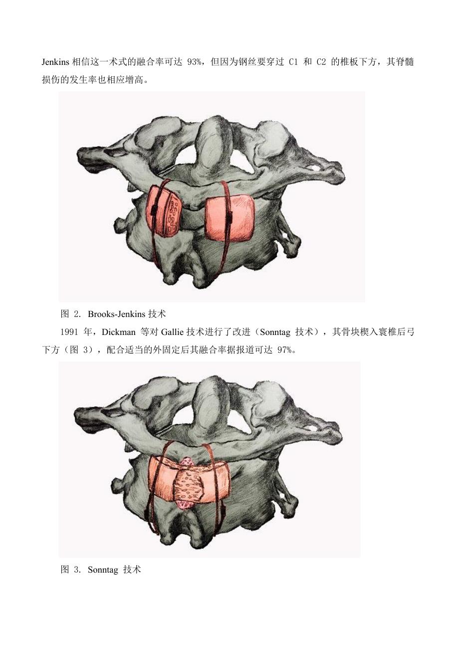 寰枢椎后路内固定术大概要.._第2页