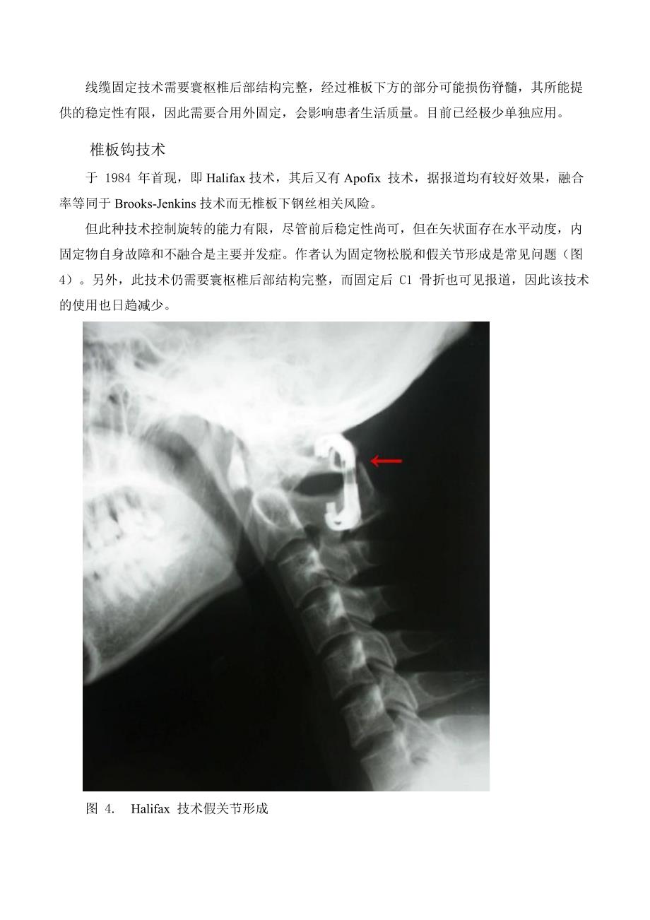 寰枢椎后路内固定术大概要.._第3页