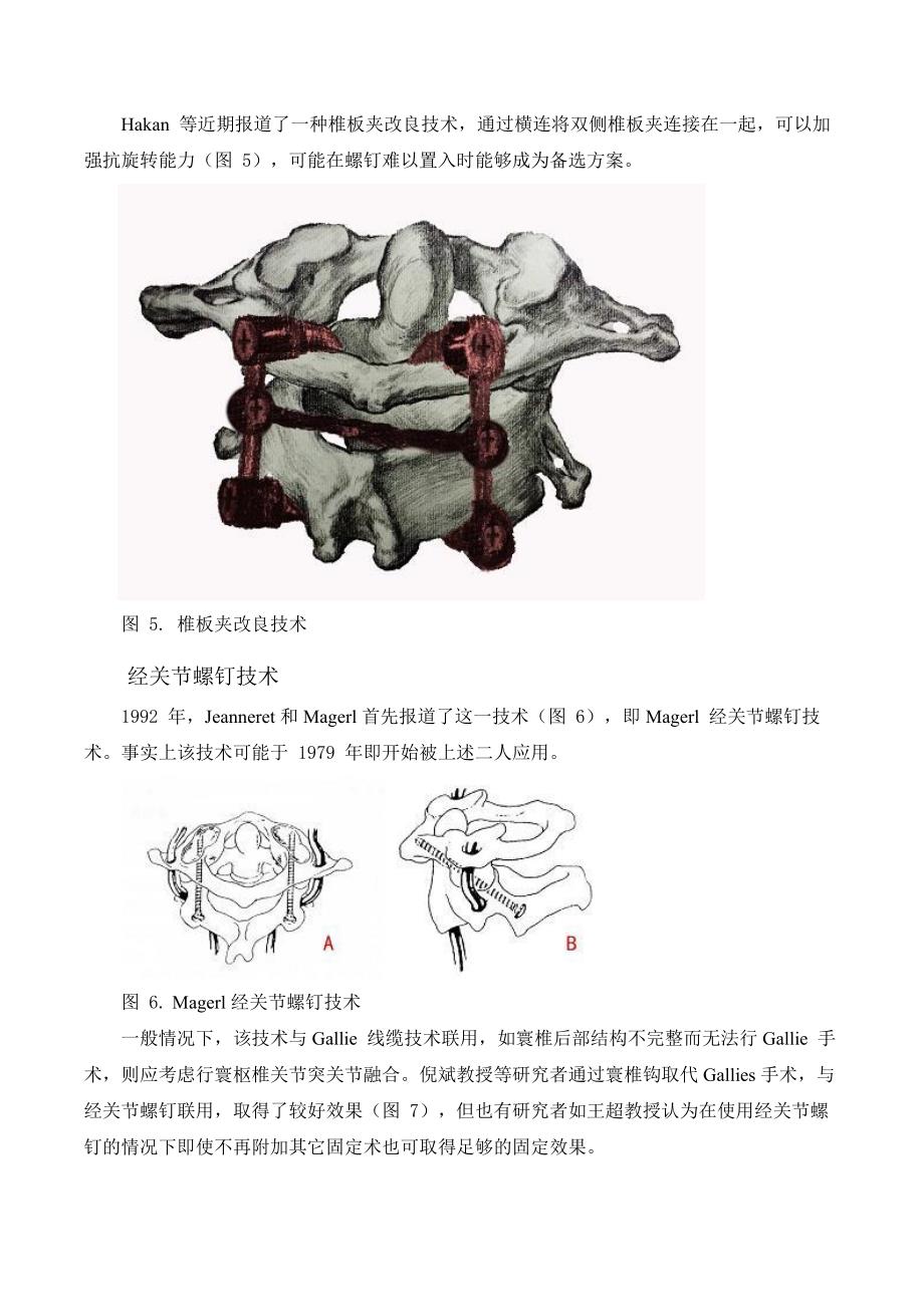 寰枢椎后路内固定术大概要.._第4页