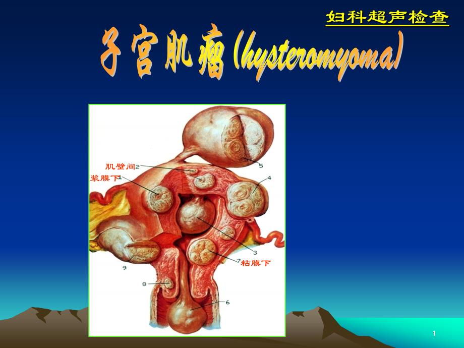 超声诊断学-11-2妇科-子宫肌瘤06-07-1_第1页