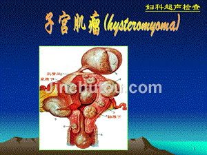 超声诊断学-11-2妇科-子宫肌瘤06-07-1
