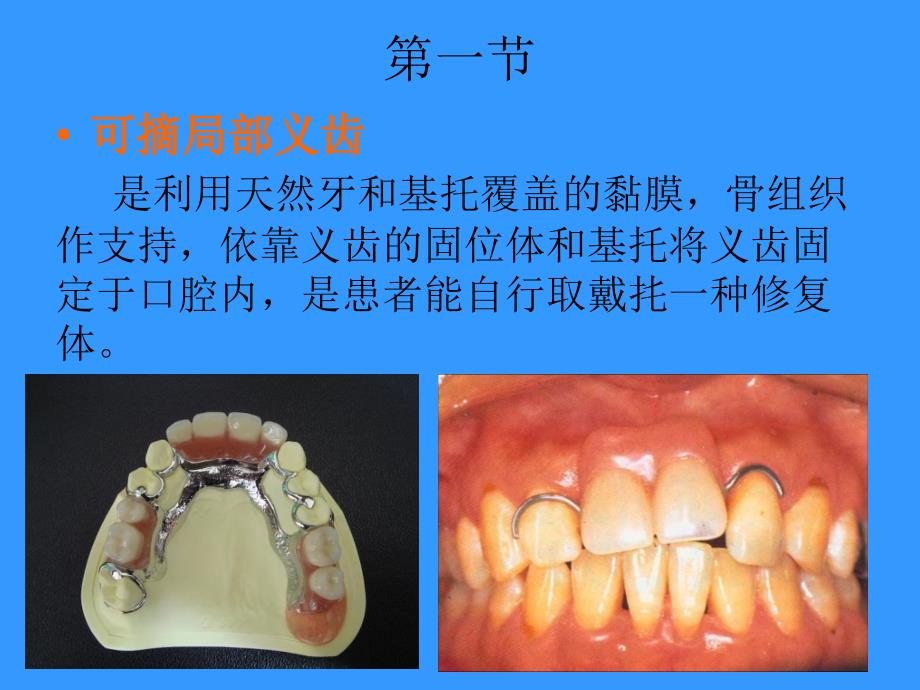 第二章可摘局部义齿修复工艺_第2页