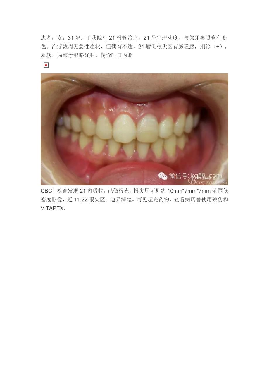 王汉禹：前牙根尖囊肿+根尖切除手术._第1页