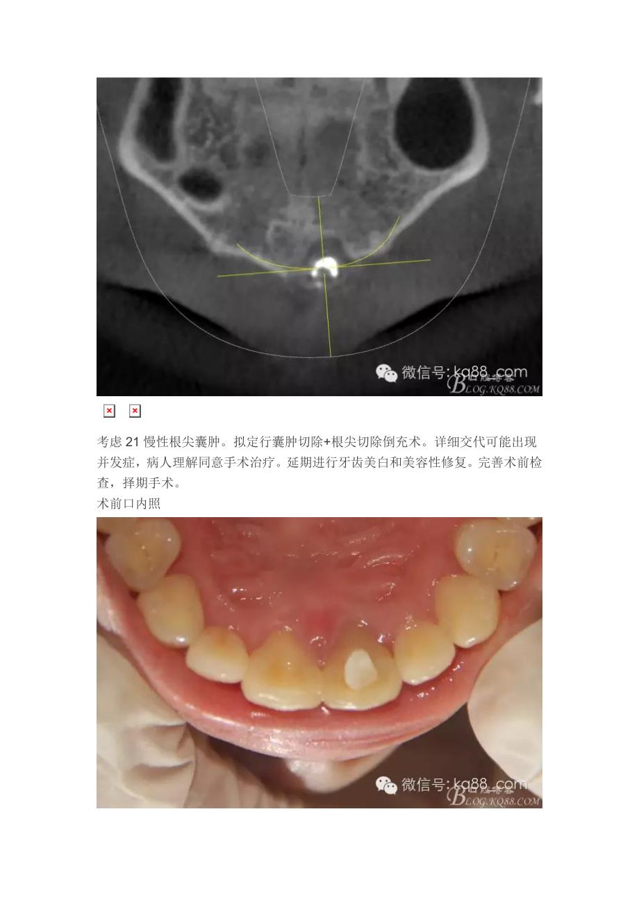 王汉禹：前牙根尖囊肿+根尖切除手术._第3页