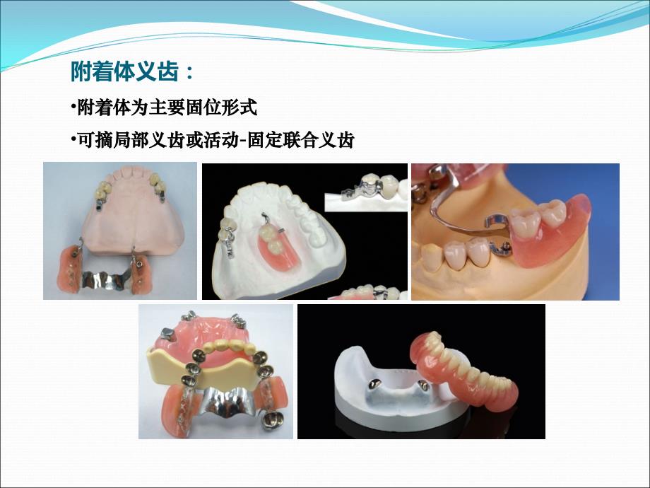 牙列缺损缺失固定活动义齿修复.._第3页