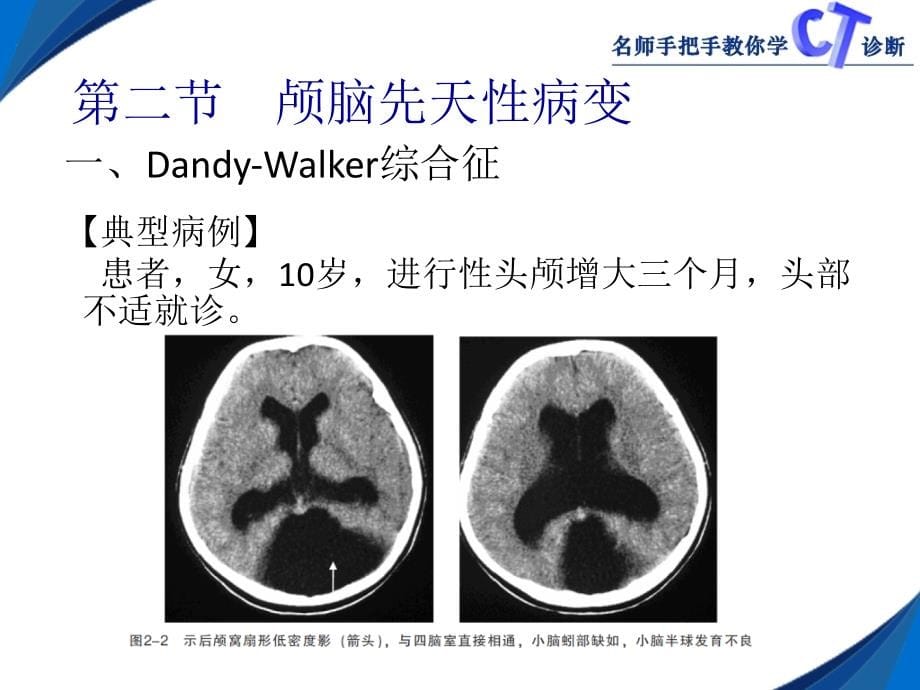 第二章__颅_脑ct_第5页