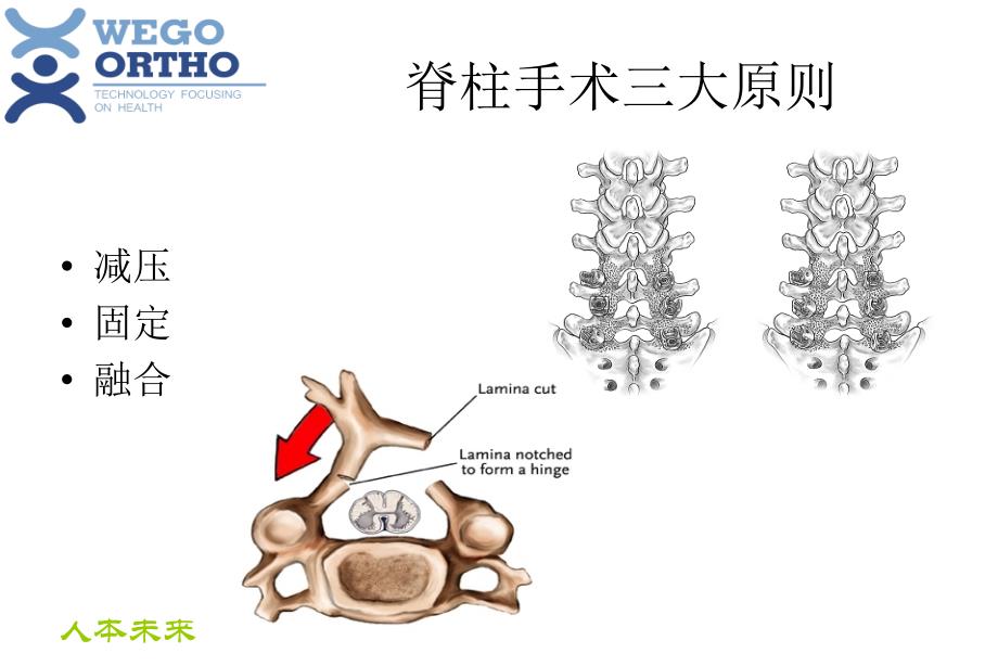 脊柱内固定原理汇总.._第4页