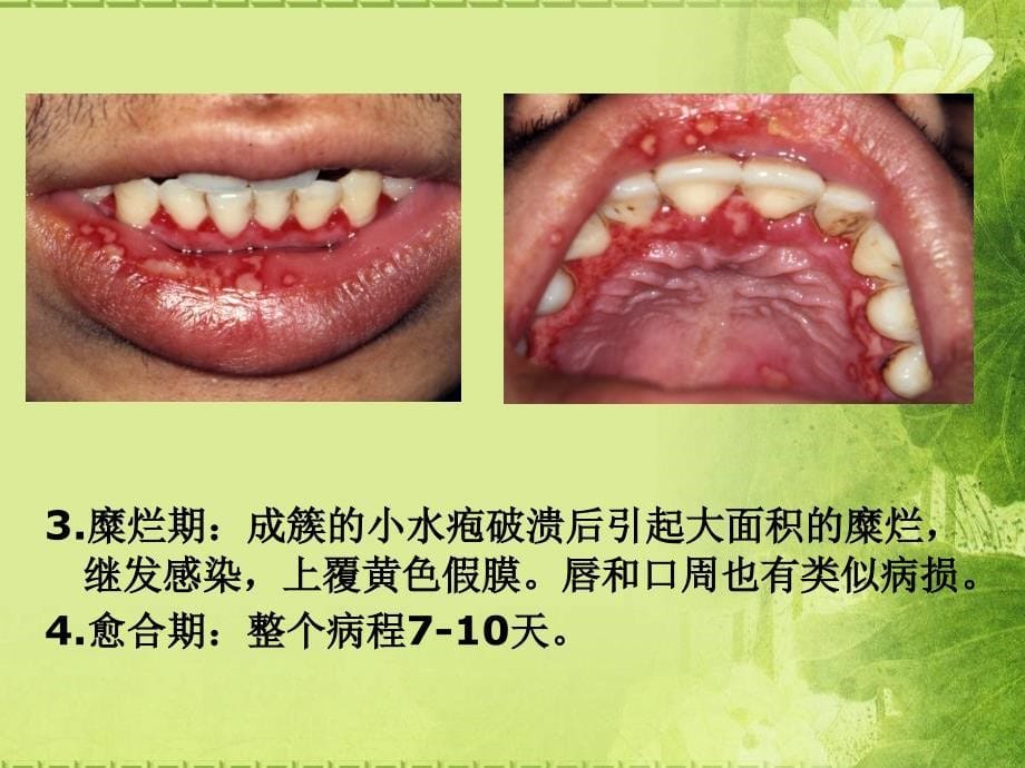 口腔科学-第六章粘膜病_第5页