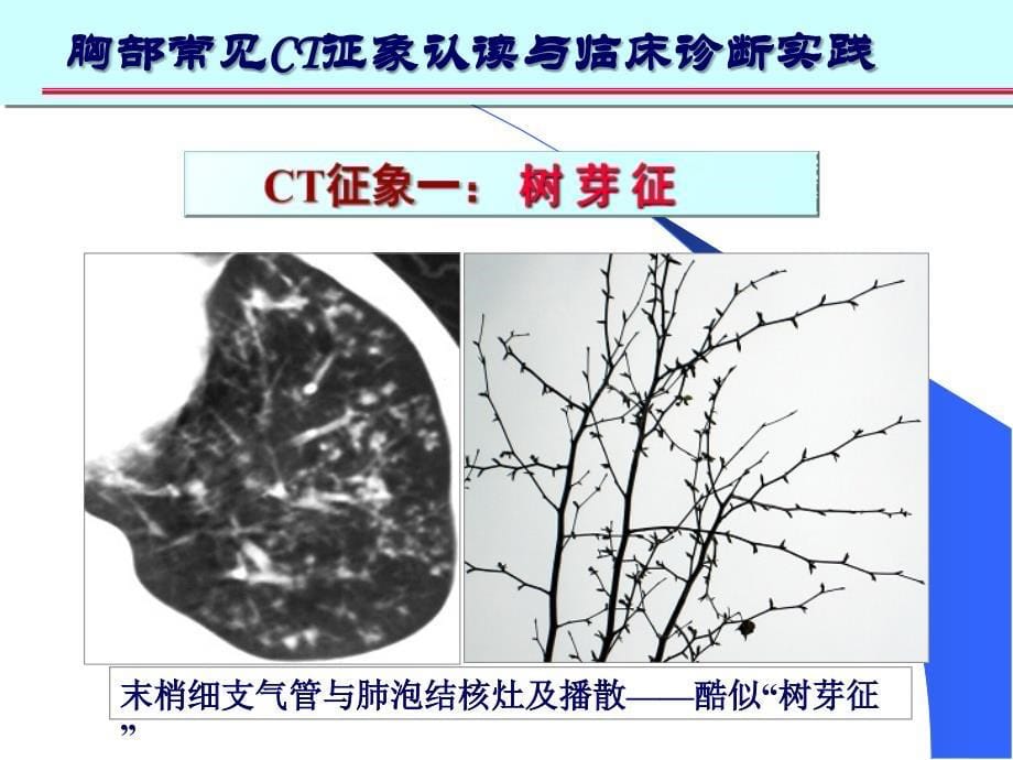 肺部ct_十大入门征象_第5页