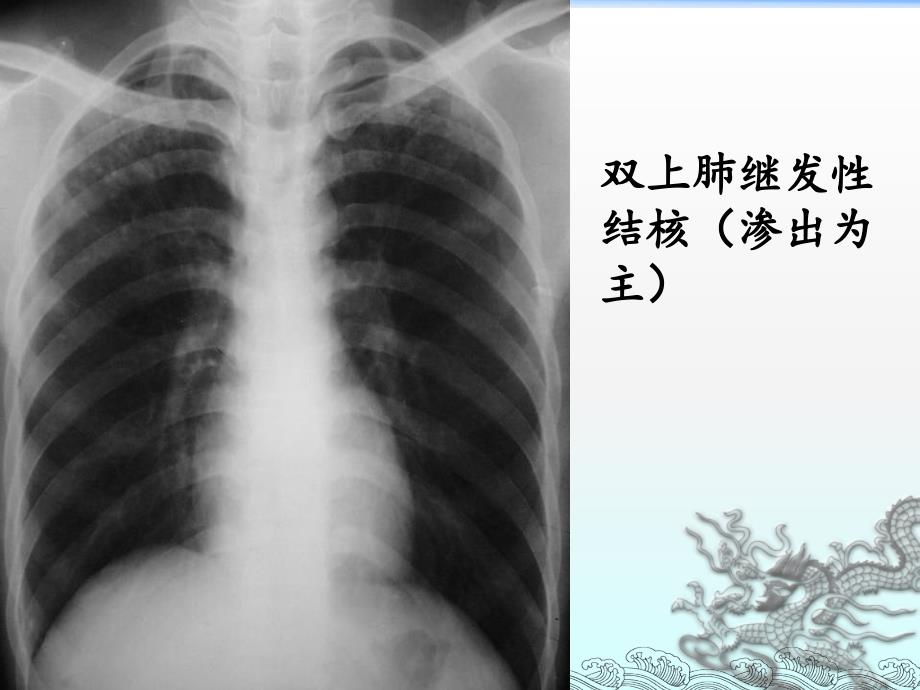 肺结核的影像诊断(x线)_9_第4页