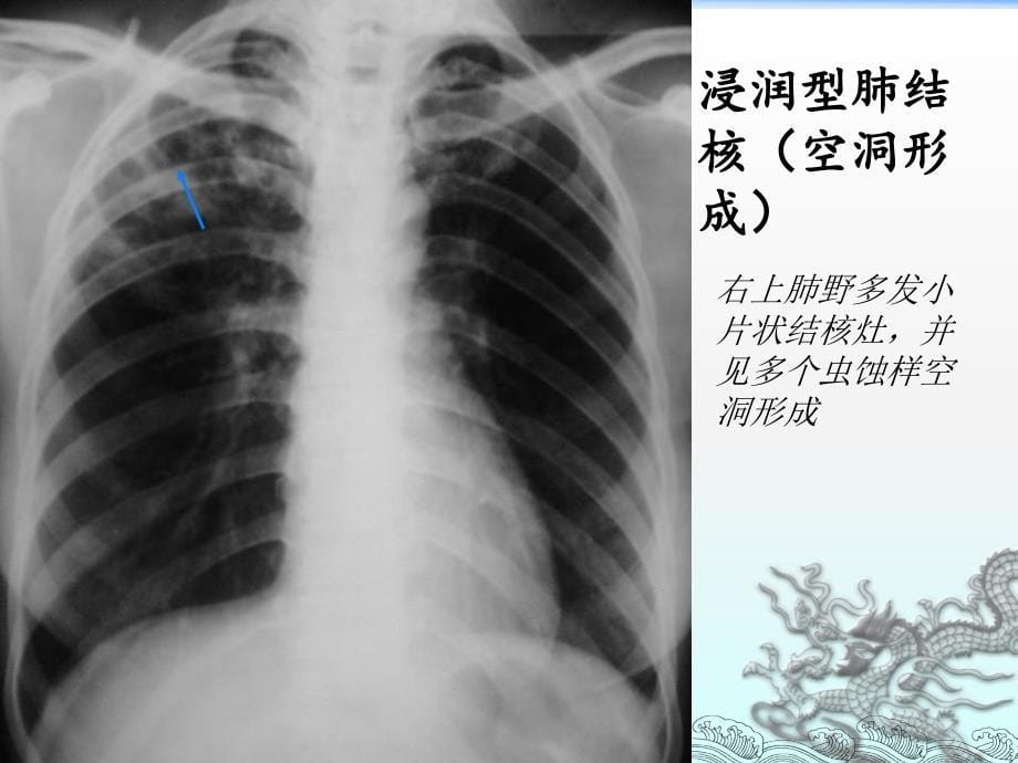 肺结核的影像诊断(x线)_9_第5页