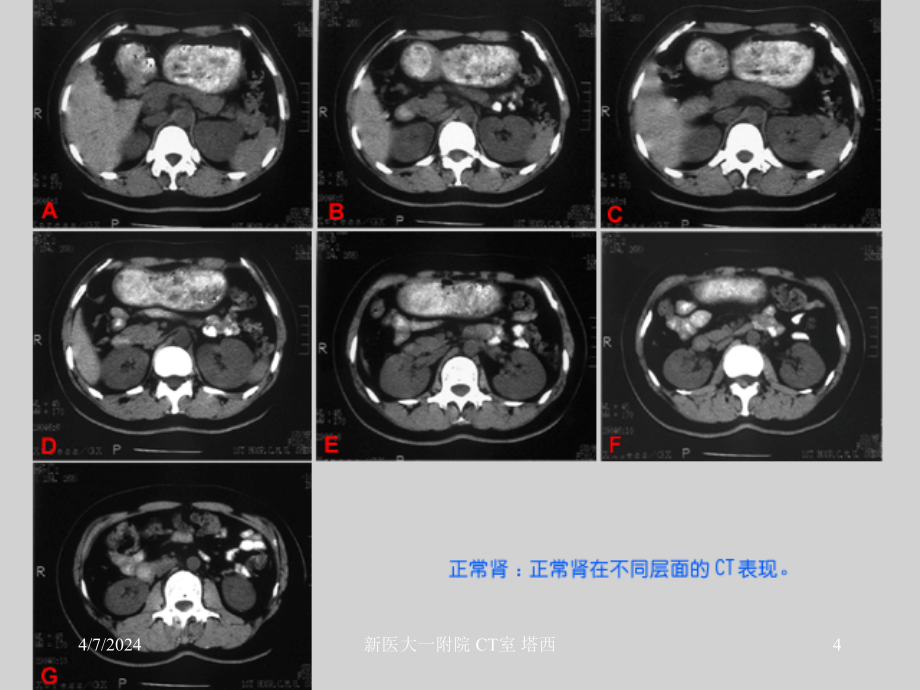 泌尿生殖系统和腹膜后间隙(新疆医科大ct诊断课件-)_第4页