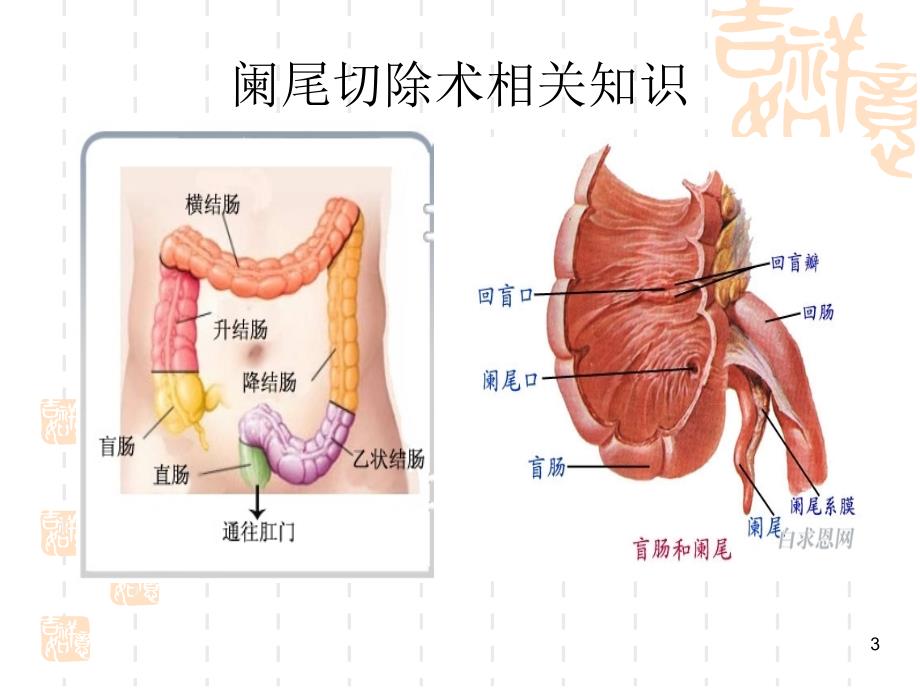 阑尾切除术相关知识及手术步骤讲义_第3页