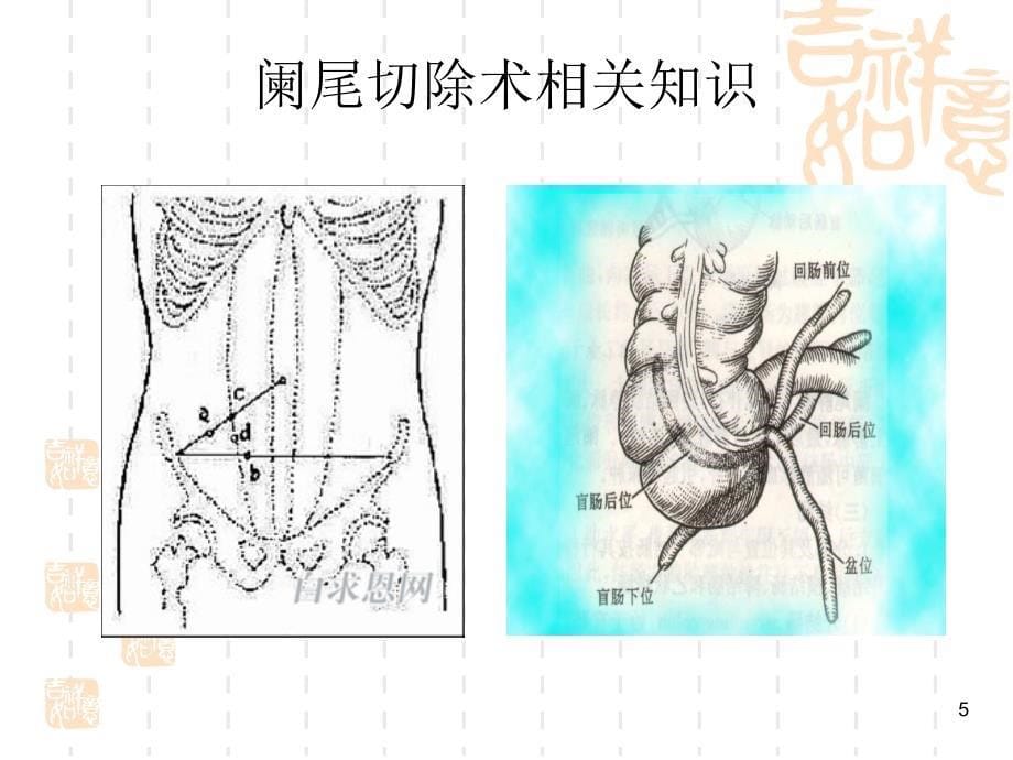 阑尾切除术相关知识及手术步骤讲义_第5页