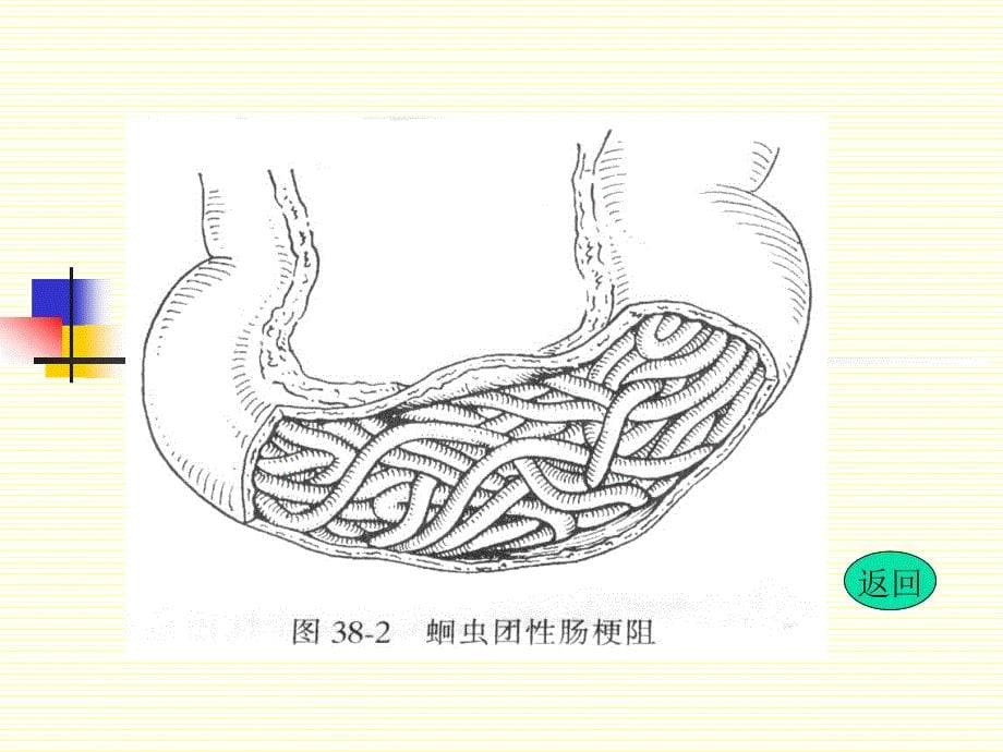 肠梗阻 intestinal obstruction_第5页