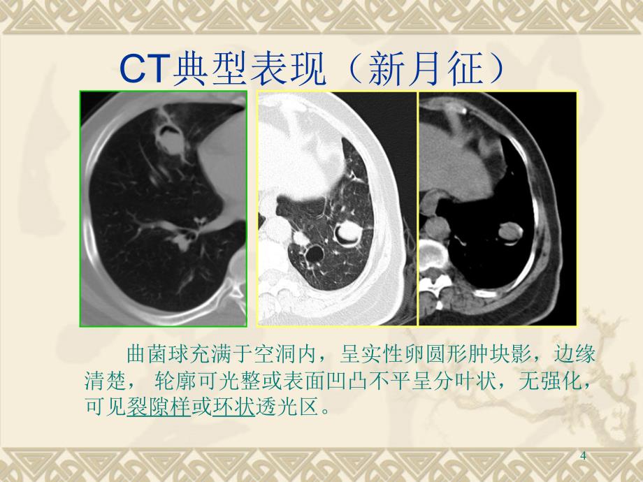 柳澄-肺曲霉菌感染的ct表现及鉴别诊断_第4页