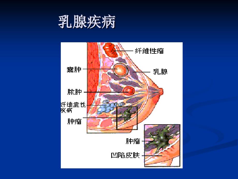 第十一章乳腺炎、乳癌5_第3页