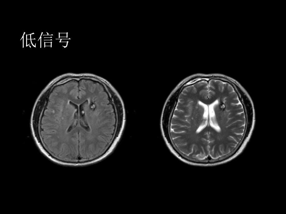 中枢神经系统疾病基本阅片技能_第5页