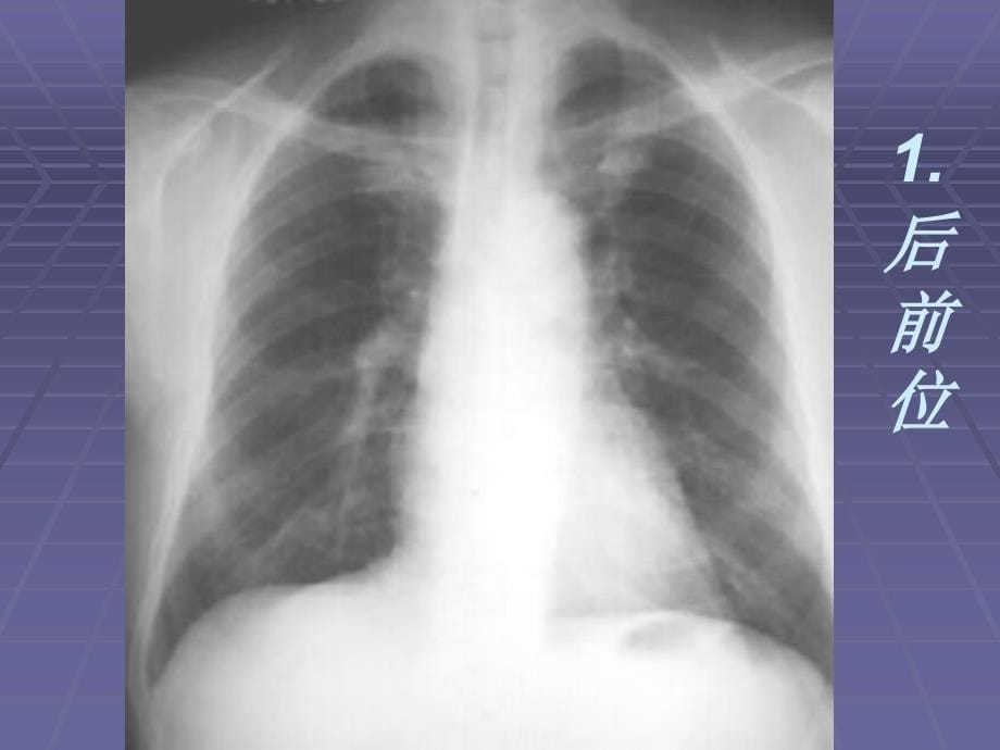 医学影像学——呼吸系统检查方法、正常x线表现、基本病变_第5页