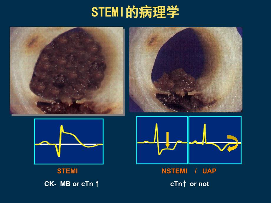 急性st段抬高型心肌梗死（药学篇）_第3页