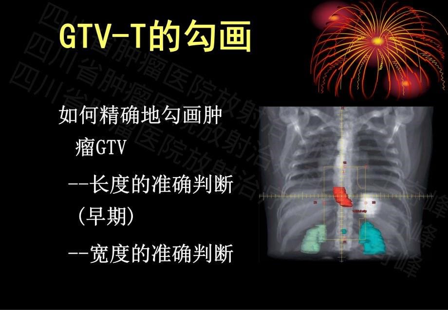 食管癌靶区勾画(含术后靶区)-李涛 王奇峰_第5页