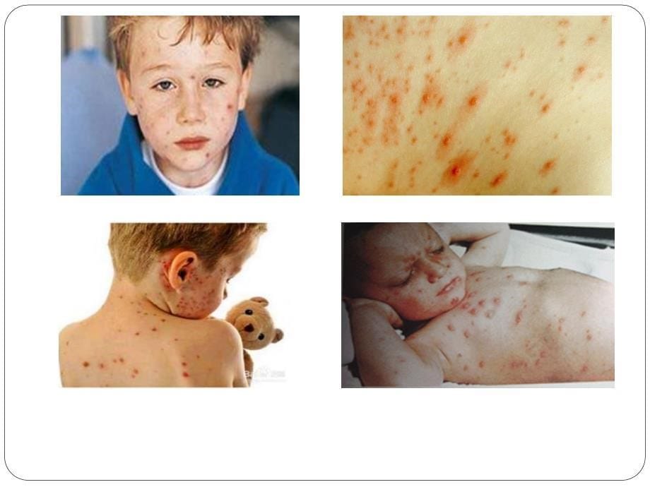 儿童常见传染病的防治知识_第5页