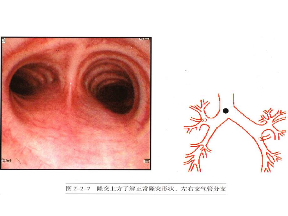 纤支镜图谱_第4页