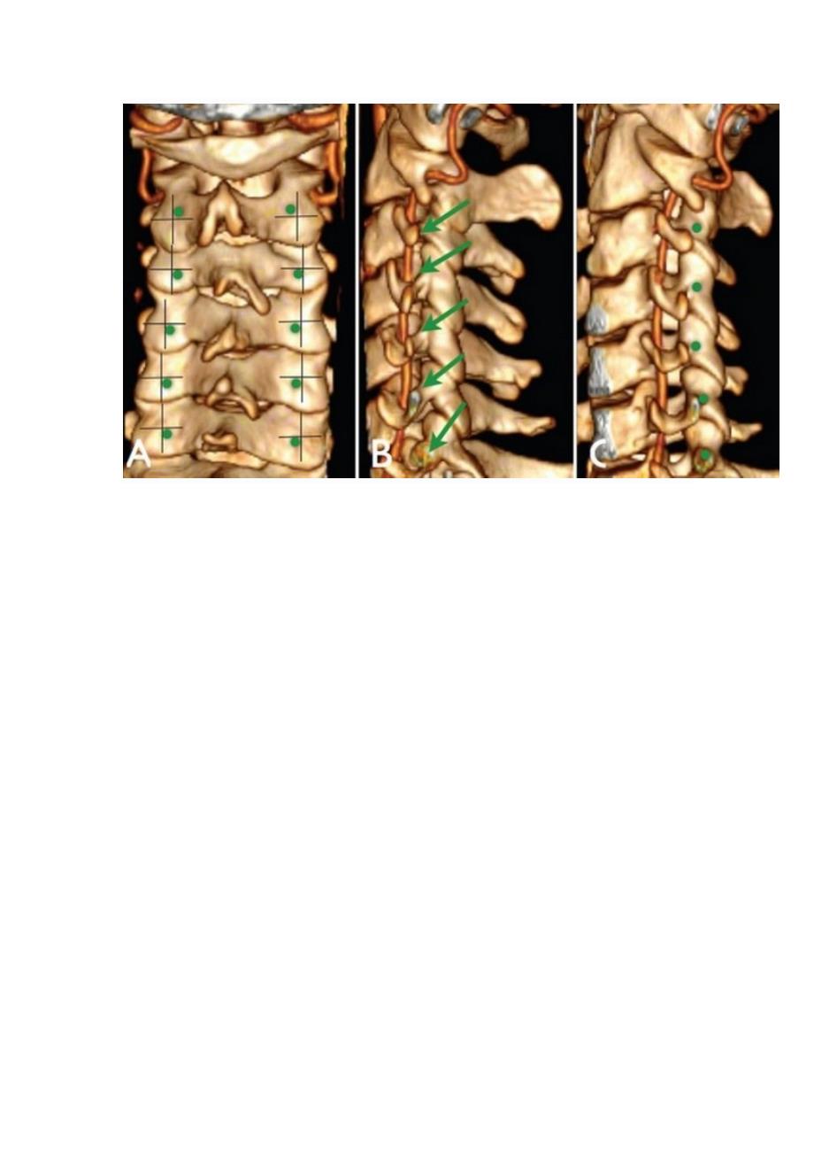 脊椎椎弓根钉进钉点确定与手术技巧_第3页