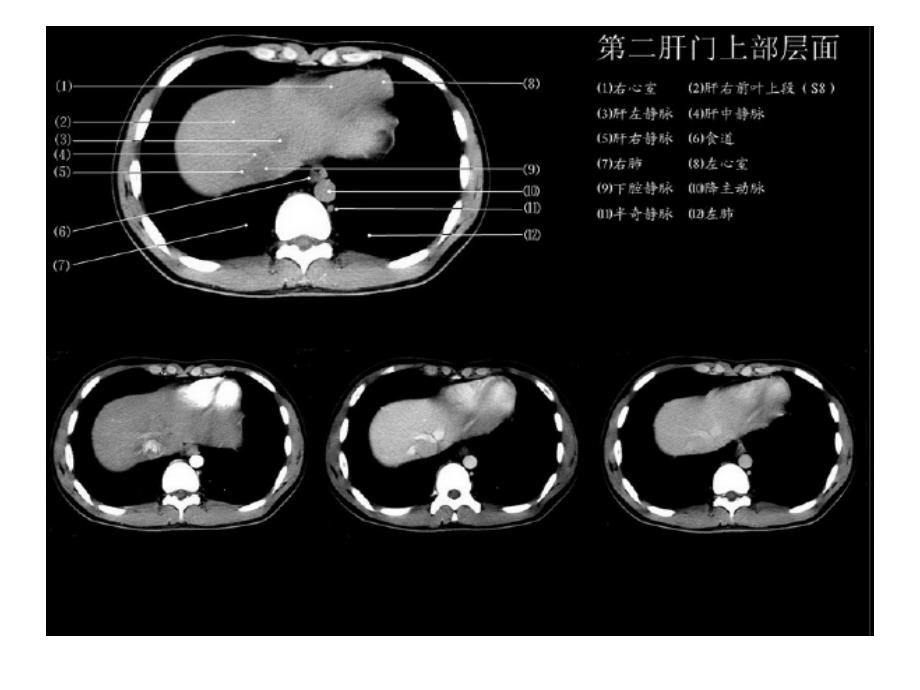 正常肝脏ct解剖_第3页