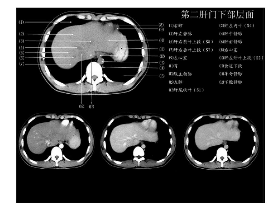 正常肝脏ct解剖_第4页